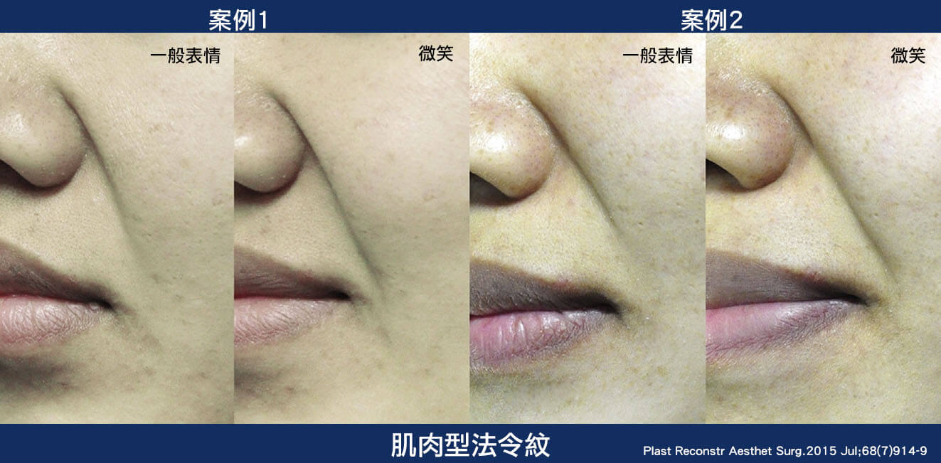 肌肉型法令紋