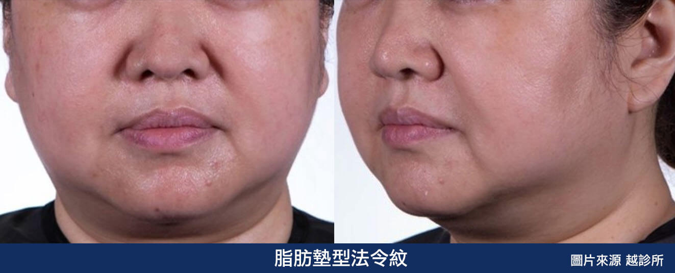 脂肪墊型法令紋