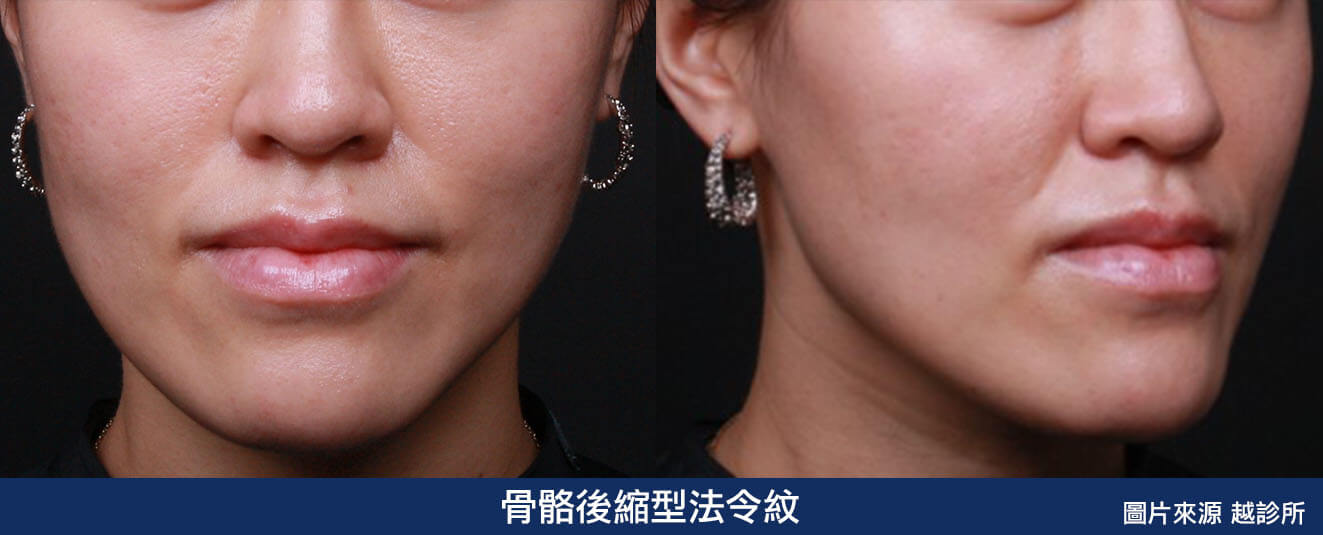 骨骼後縮型法令紋