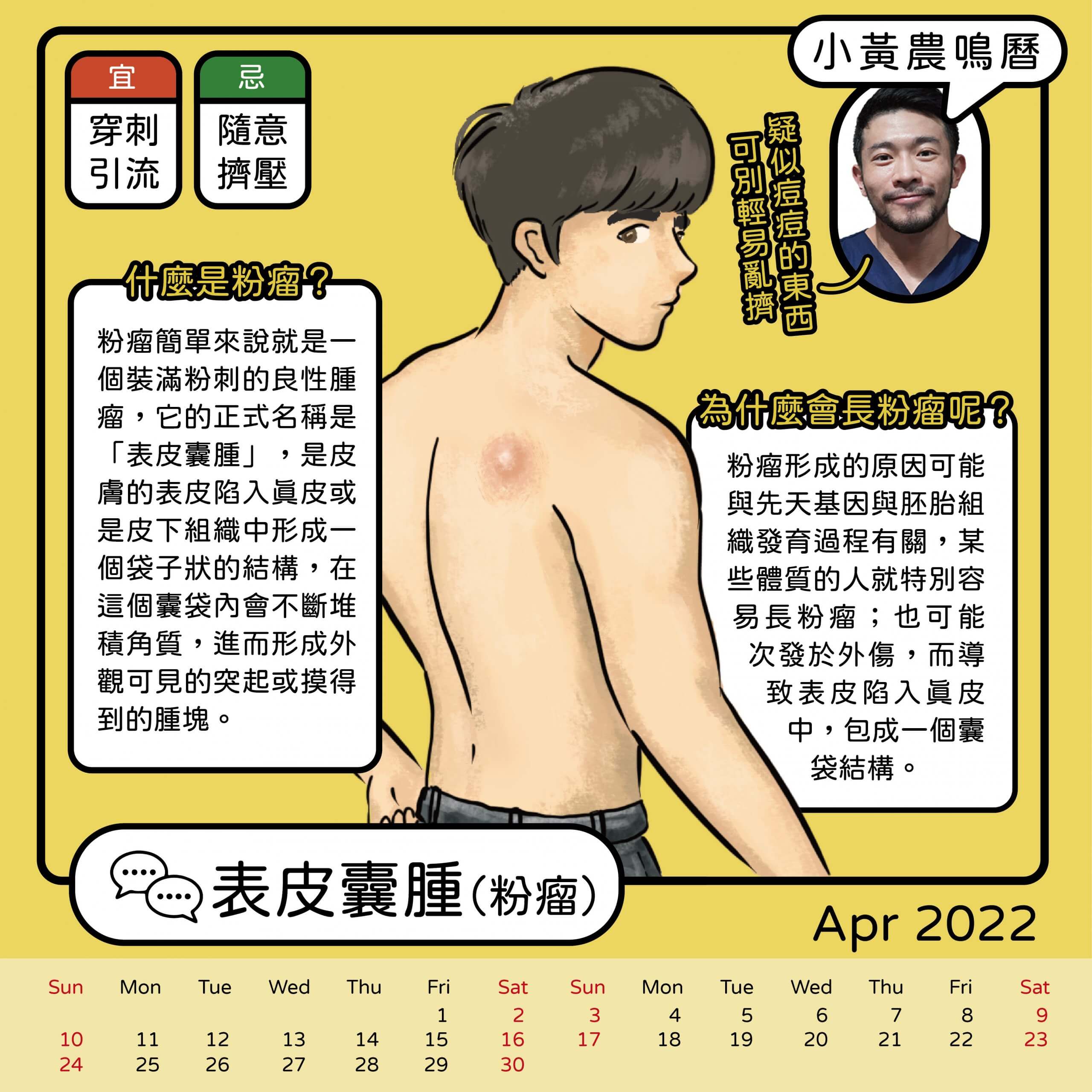 Read more about the article 表皮囊腫（粉瘤）