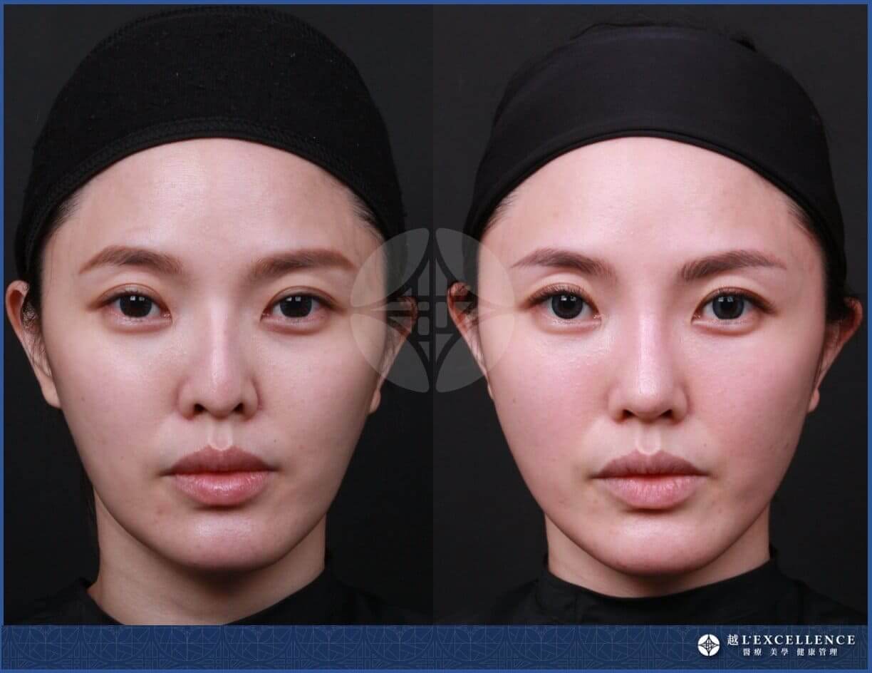 越L’EXCELLENCE隆鼻案例