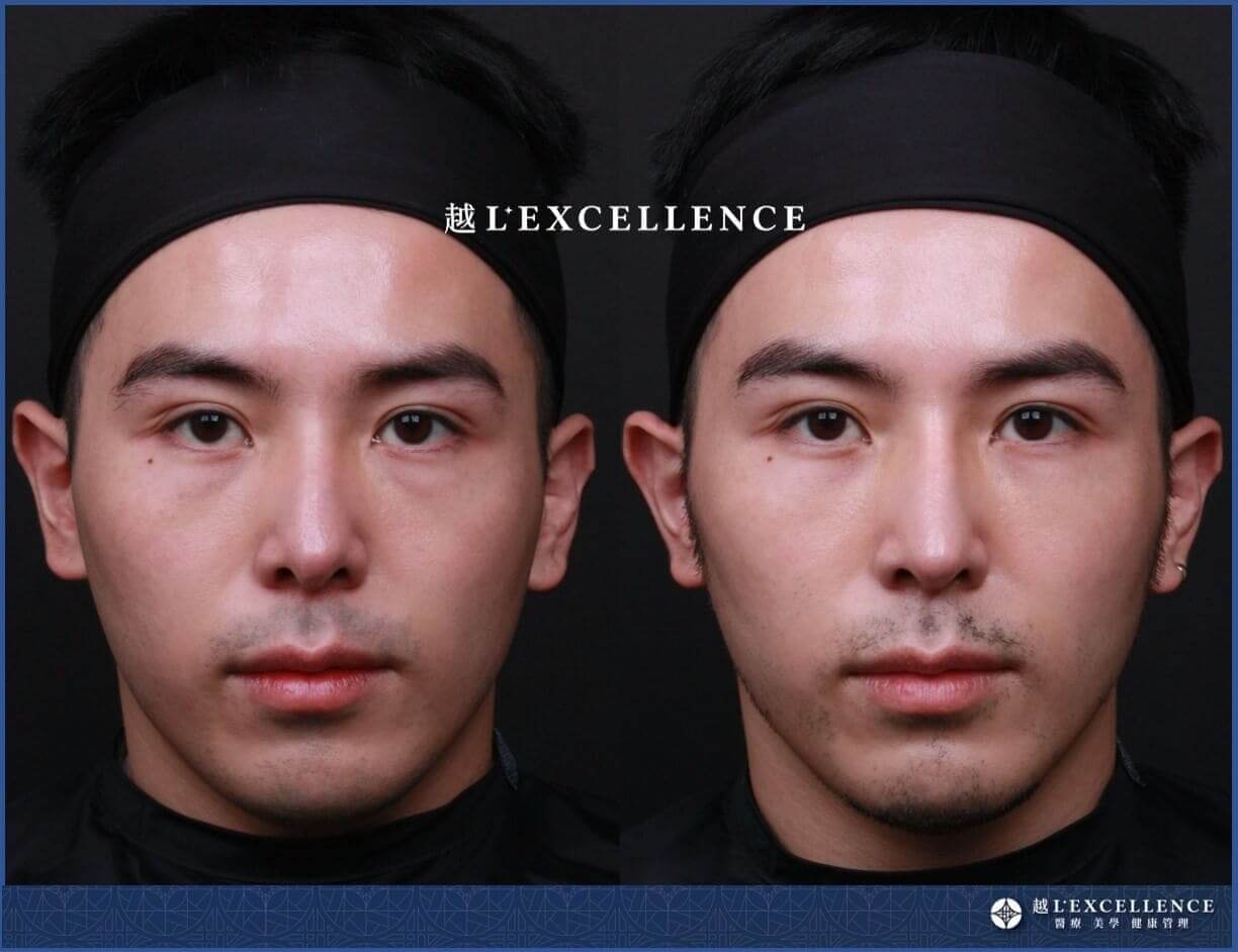 越L’EXCELLENCE隆鼻案例