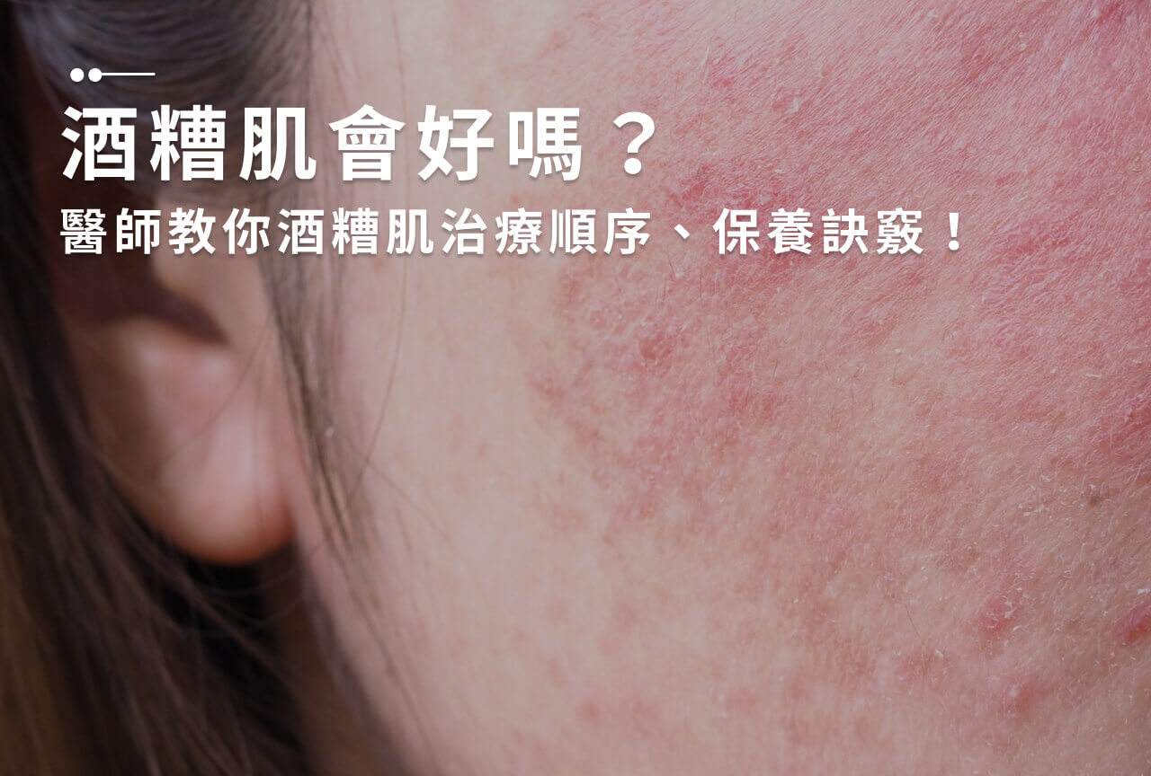 Read more about the article 酒糟肌會好嗎？醫師教你酒糟肌治療順序、保養訣竅！