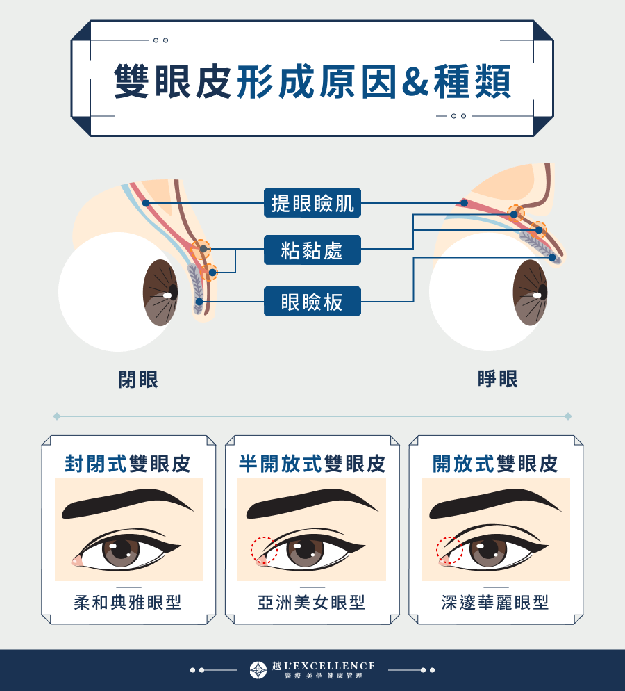 雙眼皮形成原因與種類