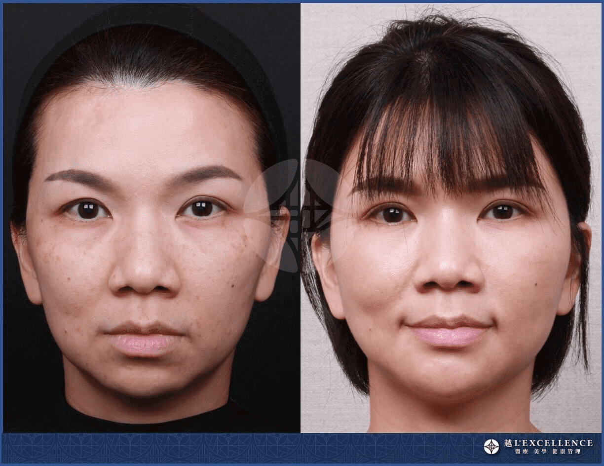 皮秒雷射功效:皮秒雷射除斑