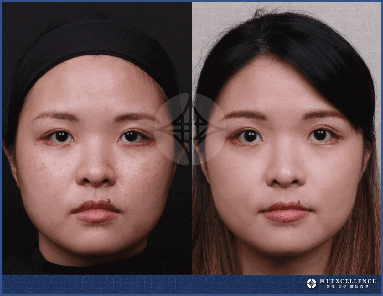 皮秒雷射功效:皮秒雷射除斑