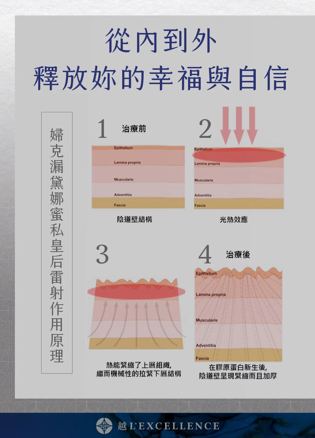 G緊雷射 漏尿 性愛不適 私密處感染 暗沉 越診所 Mb04