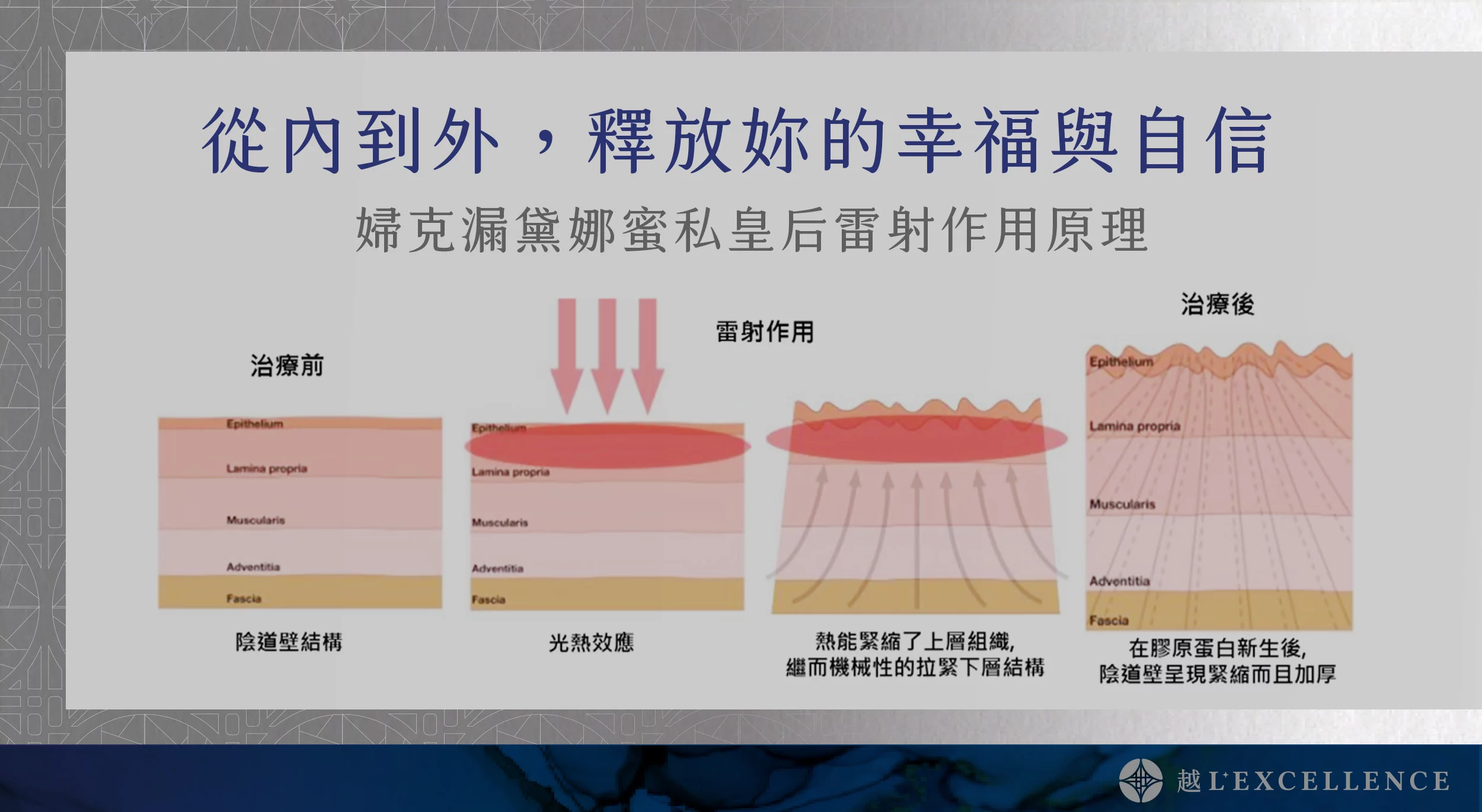 G緊雷射 漏尿 性愛不適 私密處感染 暗沉 越診所04