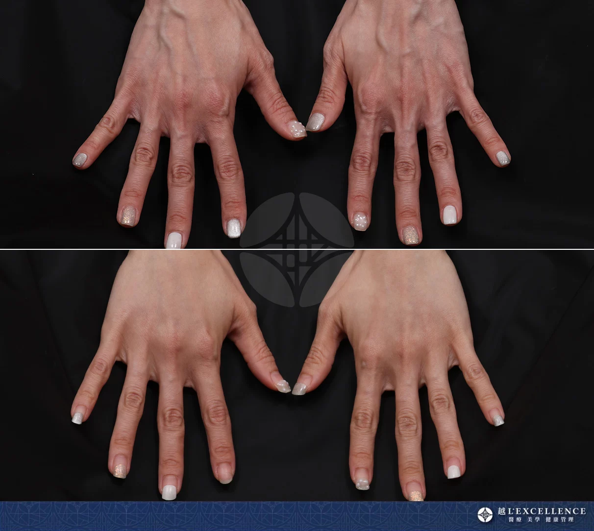 越診所 8865 愛力根Volite玻尿酸 手01