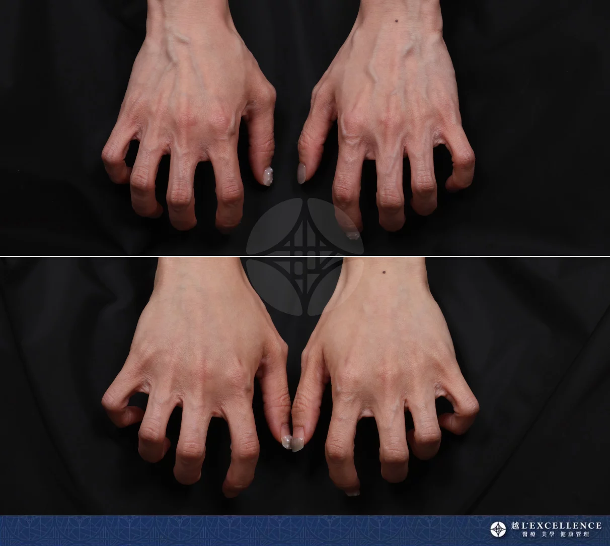 越診所 8865 愛力根Volite玻尿酸 手02