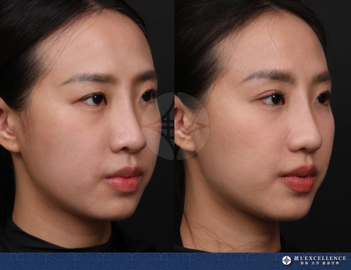 越診所9732 鼻雕 右側