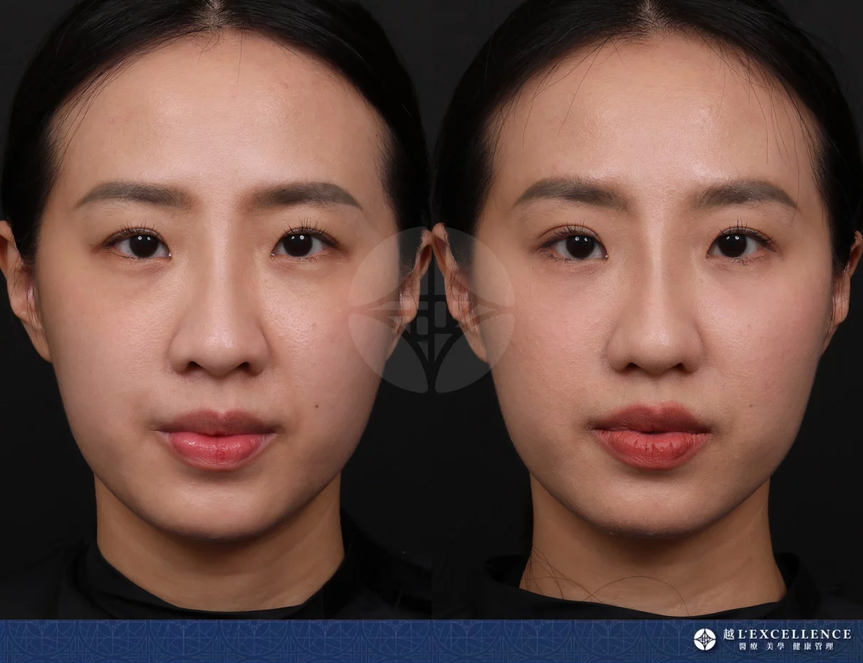 越診所9732 鼻雕 正