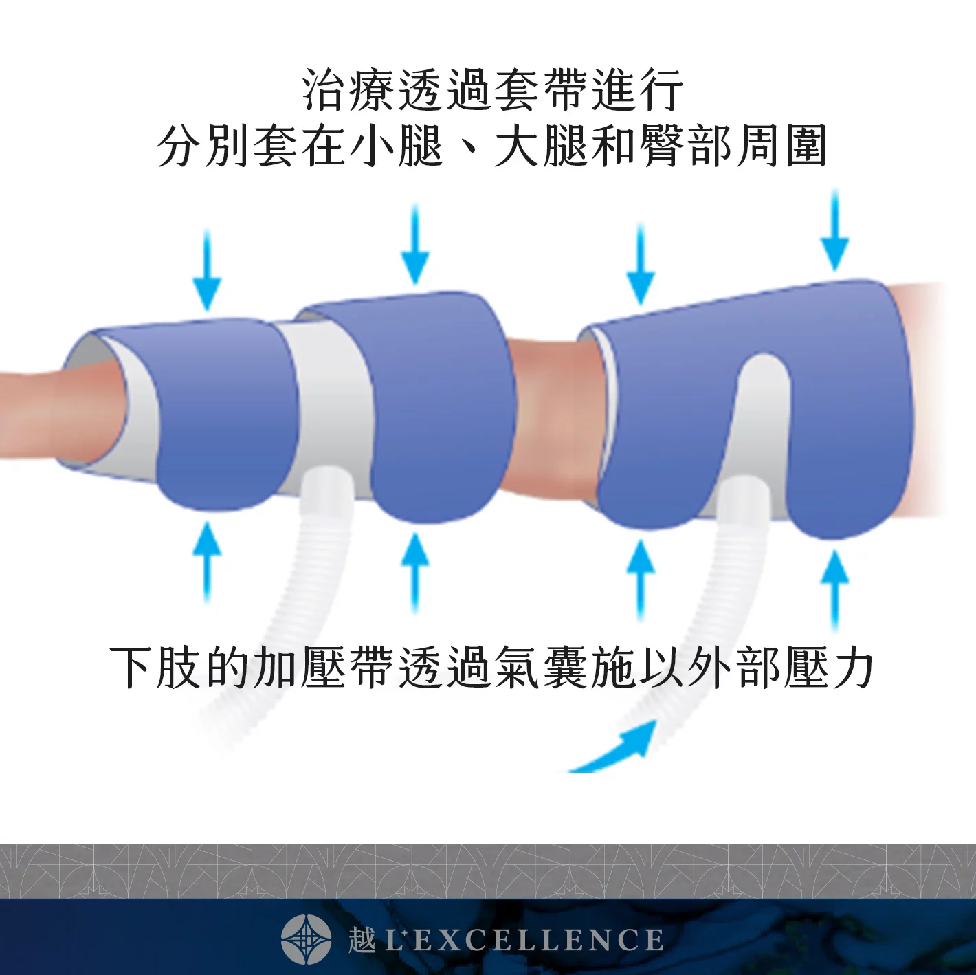 EECP、體外反搏、心臟復健、心絞痛改善、非侵入性心血管治療、血液循環療程、冠狀動脈輔助治療、促進血管新生 越診所 S03