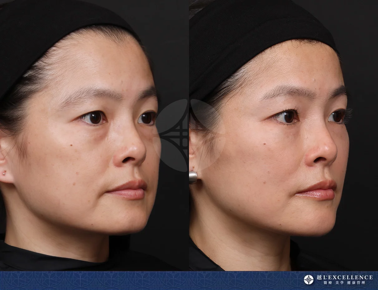 越診所 10232全臉玻尿酸 右側邊