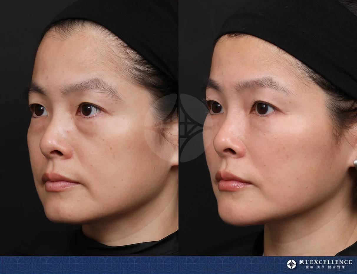 越診所 10232全臉玻尿酸 左側
